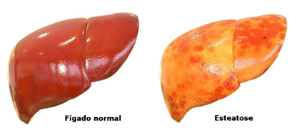 Comparação de fígados normal e com estearose