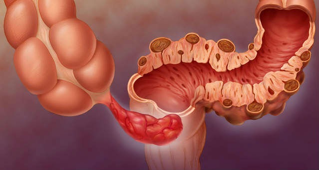 Diverticulite: causas, sintomas e tratamento